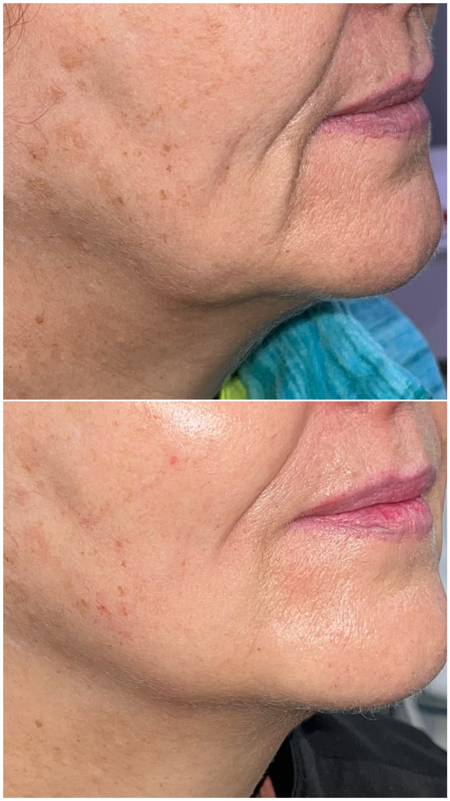 Metamorphose · 60 días: 1 HIFU + 2 radiofrecuencias monopolares + 2 microneedling con cócteles exclusivos