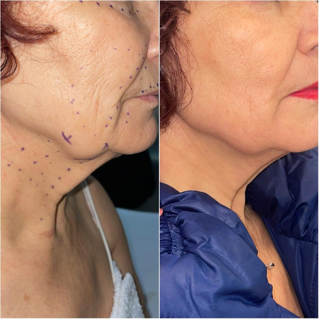 Plasma · cuello y mandíbula: 1 sesión · 30 días